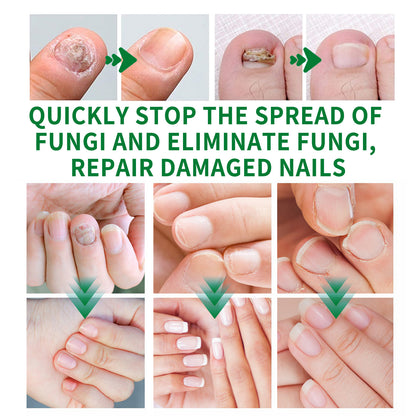 7 Days Ginger Nail Fungal Treatment